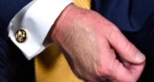 President Donald Trump's bruised hand