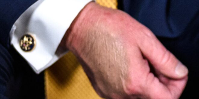 President Donald Trump's bruised hand